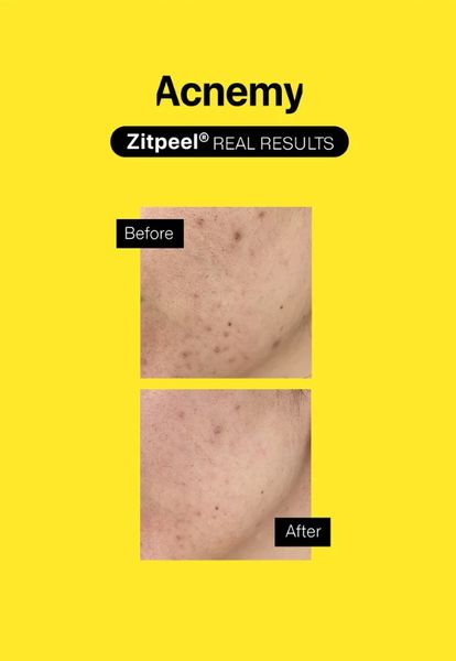 Acnemy ZITPEEL - Кислотный несмываемый пилинг для кожи склонной к акне - 40 мл 1788426117 фото